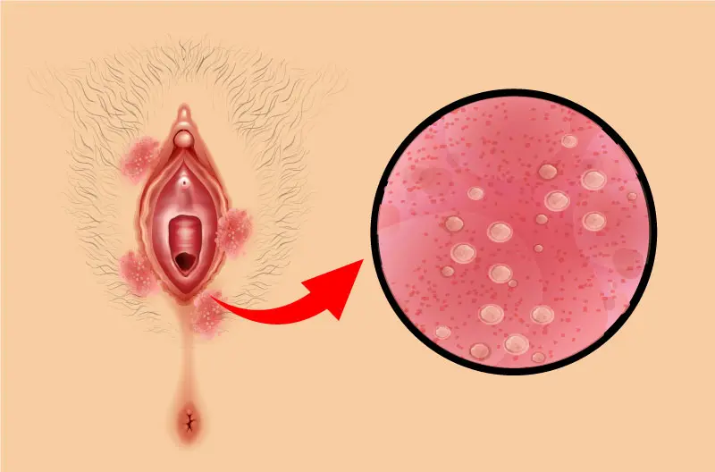 Mycose vaginale de la femme, quel traitement ? | Loosto